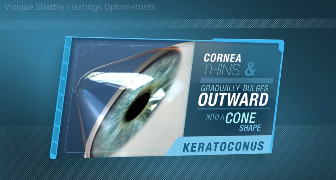 Keratoconus and Vision Correction with Contact Lenses Shattky